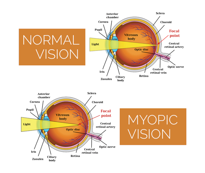 Diagram comparing normal vision to myopic vision