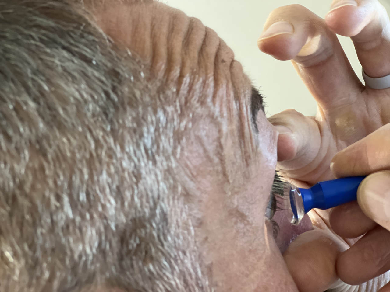 Man getting fitted with scleral lens